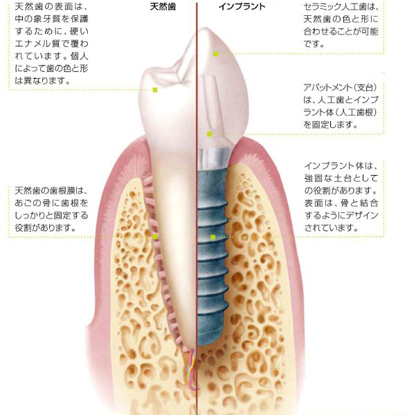 インプラントとは