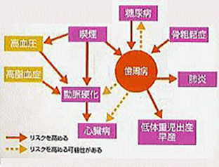 本当は怖い歯周病