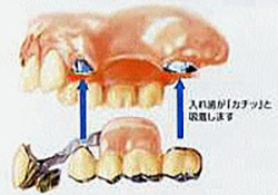 磁石方式の入れ歯